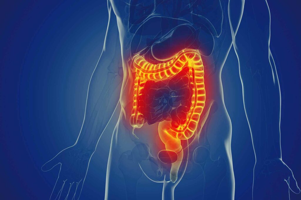 Irritable Bowel Syndrome